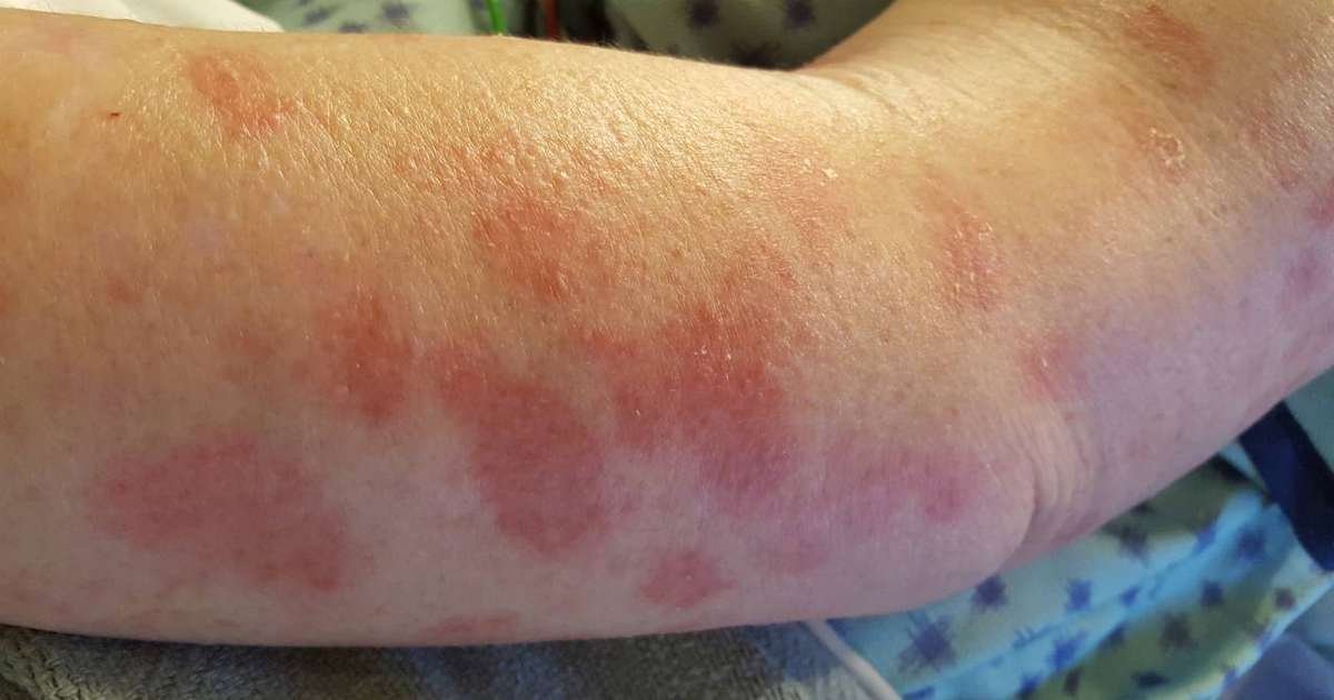 Imagem ilustrativa da hanseníase, mostrando diferentes tipos de manchas na pele